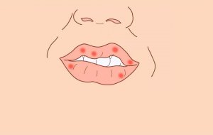 Как избавиться от простуды на губах: причины, лечение и профилактика герпеса