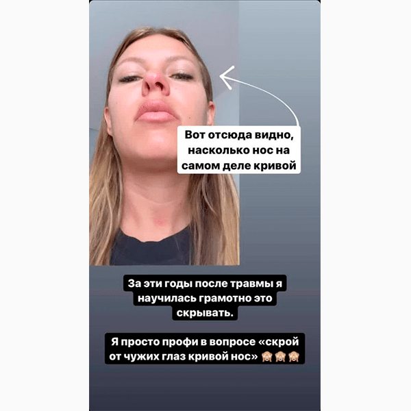 Рита Дакота показала результат ринопластики