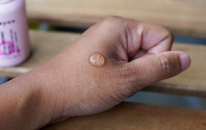 В каких продуктах содержится гиалуроновая кислота