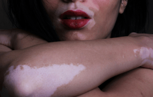 Можно ли загорать при витилиго