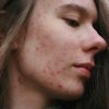 Как убрать постакне в домашних условиях?
