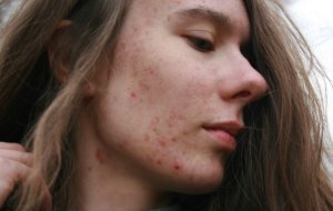 Как убрать постакне в домашних условиях?