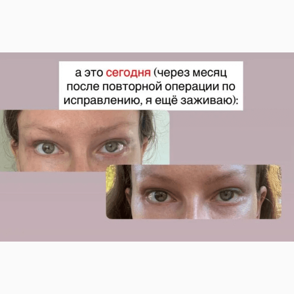 Рита Дакота откровенно рассказала о последствиях неудачной пластики