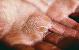 Люди-рыбки: симптомы ихтиоза и быть ли с партнером с таким геном