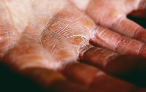 Трескается кожа на пальцах рук: причины и что делать