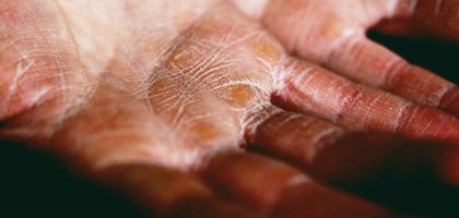 Трескается кожа на пальцах рук: причины и что делать